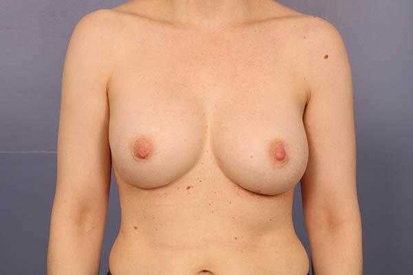 مراجعة زراعة الثدي