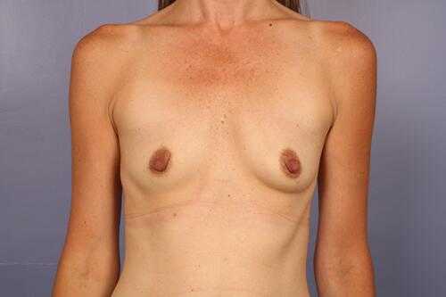 تكبير الثدي بنقل الدهون